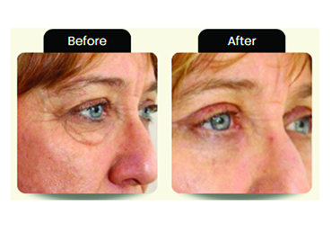 Nuvissa Plasma Pen - Before & After